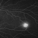 Isolated Retinal Capillary Hemangioblastoma - Late phase IVFA