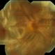 Retinal Detachment With PVR Retinal Detachment With PVR