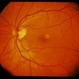 Adult Foveomacular Dystrophy / Pattern Adult Foveomacular Dystrophy / Pattern