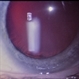 Marfan's  Syndrome Ocular Manifestation Marfan's  Syndrome Ocular Manifestation