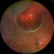 Giant Retinal Cyst Giant Retinal Cyst