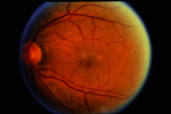 bear tracks retina treatment bear tracks retina treatment