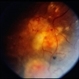 Angioma from Chronic Retinal Detachment Angioma from Chronic Retinal Detachment