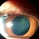 Lens displacement Lens displacement