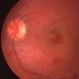 Traumatic Macular Hole Traumatic Macular Hole