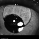 Silicone Oil Bubble in Anterior Chamber -  20 Degree Angle Silicone Oil Bubble in Anterior Chamber -  20 Degree Angle