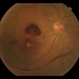 Layer Cake; Sub-retinal, Pre-retinal, Vitreous Hemorrhages Layer Cake; Sub-retinal, Pre-retinal, Vitreous Hemorrhages