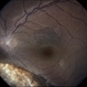 Choroidal Coloboma Choroidal Coloboma