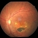 Stargardt Macular Dystrophy Stargardt Macular Dystrophy