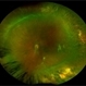 Familial Exudative Vitreoretinopathy Familial Exudative Vitreoretinopathy