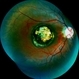 Macular Coloboma With Macular Dystrophy Macular Coloboma With Macular Dystrophy
