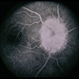 Congenital Disc Anomaly Congenital Disc Anomaly