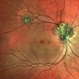 Retinal Astrocytic Hamartoma Retinal Astrocytic Hamartoma