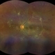Florid Proliferative Diabetic Retinopathy Florid Proliferative Diabetic Retinopathy