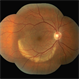 Acute Syphilitic Posterior Placoid Chorioretinopathy Acute Syphilitic Posterior Placoid Chorioretinopathy
