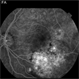 Choroidal Osteoma Choroidal Osteoma