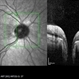 Vertical OCT Scan Through Right Optic Disc Pit Vertical OCT Scan Through Right Optic Disc Pit