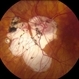 Myopic Degeneration With RPE Loss