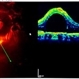 Sub macular perfluorocarbon liquid Sub macular perfluorocarbon liquid