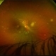 Choroidal Miliary Tubercles