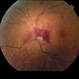 Central Retinal Vein Occlusion