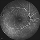 X-Linked Retinoschisis X-Linked Retinoschisis