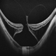 Myopic Traction Maculopathy Myopic Traction Maculopathy