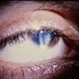 Myotonic Dystrophy
