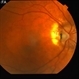 Optic Nerve Pit Related Serous Retinal Detachment