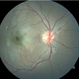 Traumatic Macular Hole