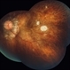 Post Pars Plana Vitrectomy Post Pars Plana Vitrectomy
