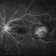 FA: Choroidal Aspergilloma With Secondary Choroidal Neovascularization and Exudative Retinal Detachment FA: Choroidal Aspergilloma With Secondary Choroidal Neovascularization and Exudative Retinal Detachment