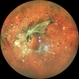 Tractional Retinal Detachment Tractional Retinal Detachment