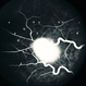 Retinal Capillary Hemangioblastoma Retinal Capillary Hemangioblastoma