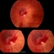 Retinal Hemorrhage Retinal Hemorrhage