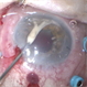 Removing a Hypopyon From the Anterior Segment Removing a Hypopyon From the Anterior Segment