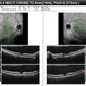Syphilitic  Posterior Uveitis Syphilitic  Posterior Uveitis