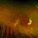Coats' Disease Coats' Disease