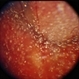 Choroidal Melanoma With Vitreous Seeding Choroidal Melanoma With Vitreous Seeding