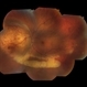 Ocular Metastasis of Breast Cancer Ocular Metastasis of Breast Cancer