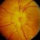 Disc Edema