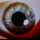 Wilson's Disease Wilson's Disease