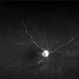 Central Retinal Artery Occlusion