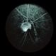 Optic Disc Melanocytoma Optic Disc Melanocytoma
