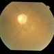 Dengue Retinitis Healed With Optic Atrophy