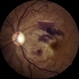 Macular Scarring Following Blunt Trauma Macular Scarring Following Blunt Trauma
