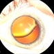 Marfans Dislocation With Zonules