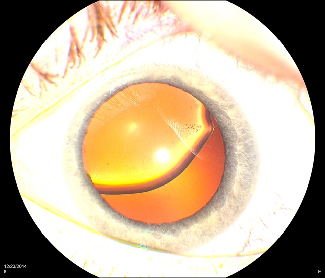 Marfans dislocation with zonules retina image bank