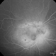 Diffuse Choroidal Hemangioma Diffuse Choroidal Hemangioma