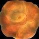 Acute Syphilitic Posterior Placoid Chorioretinitis Acute Syphilitic Posterior Placoid Chorioretinitis